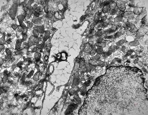 lipid malabsorption lipid malabsorption